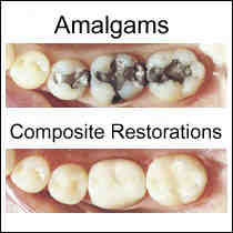 Can any dentist remove mercury fillings?