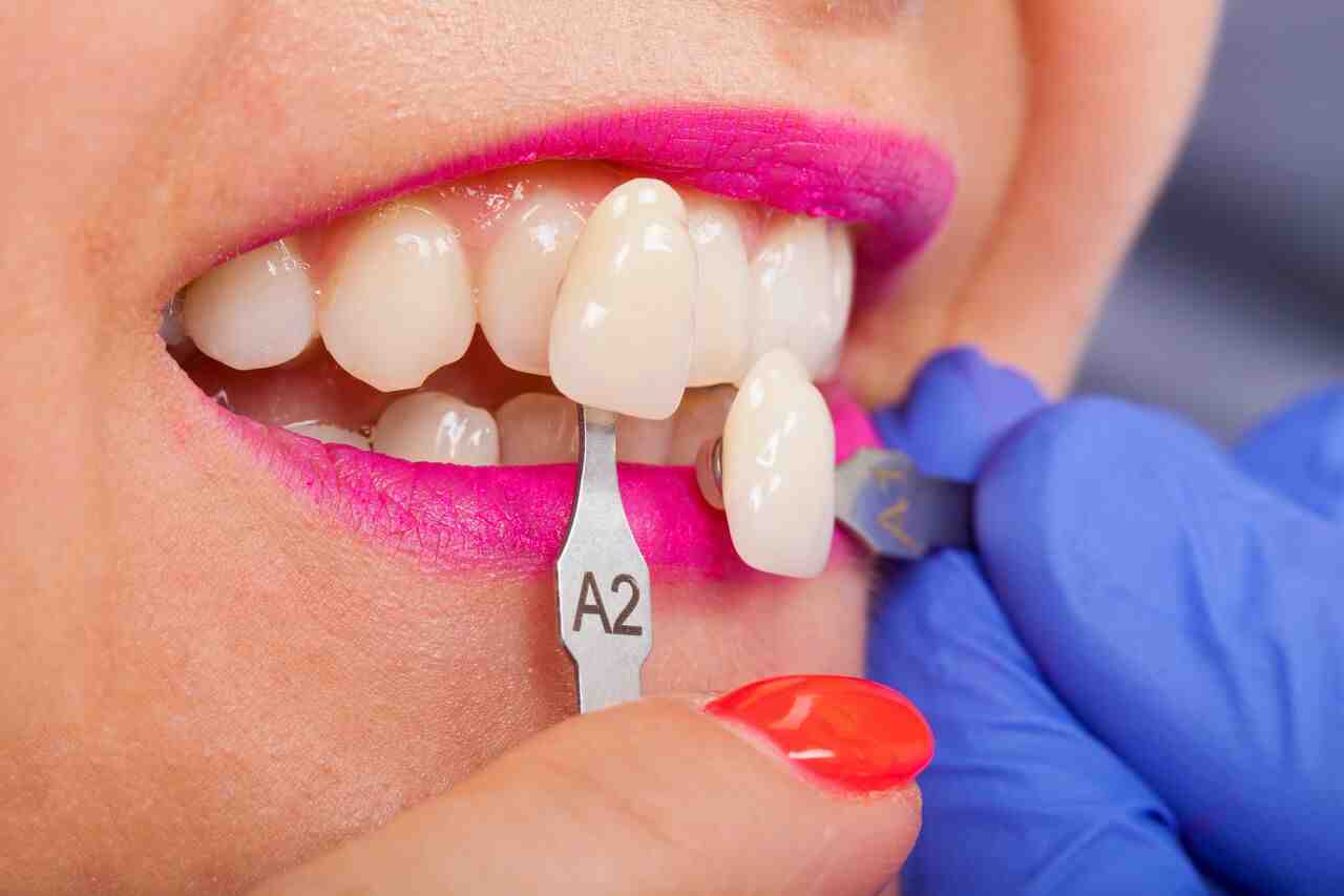 How Much Does a full dental makeover cost?