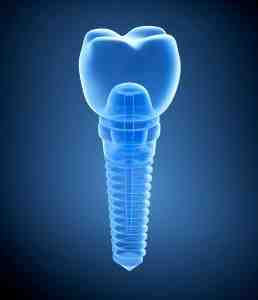 How can I get free dental implants?