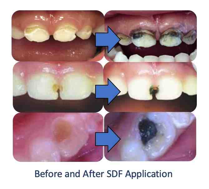 How do you treat teeth?