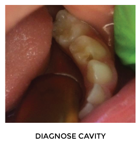 How long does SDF last on teeth?