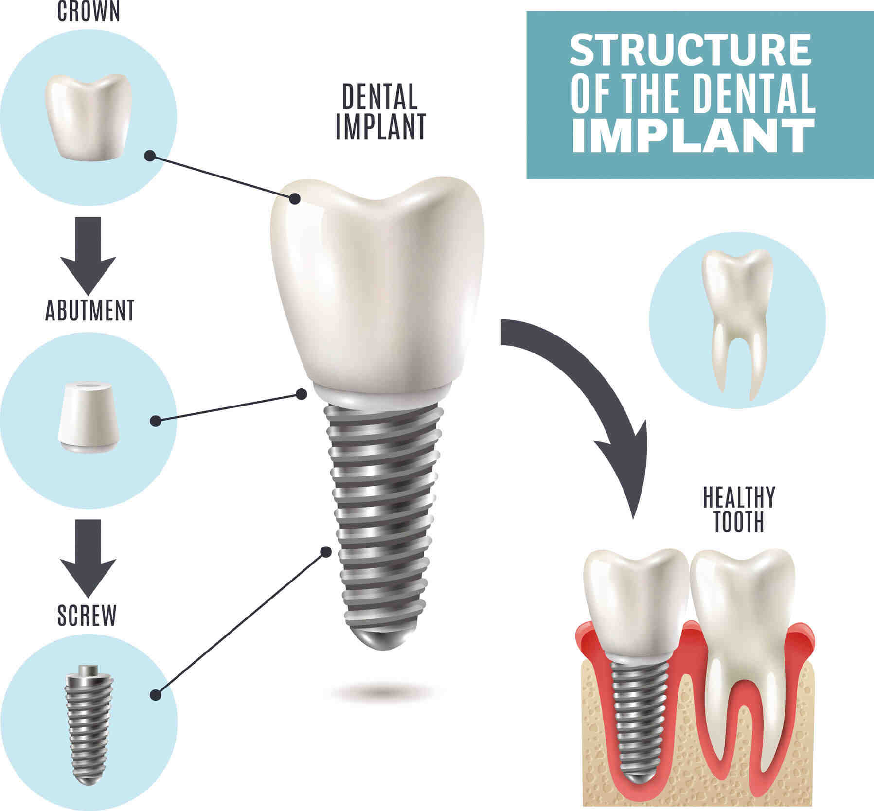 How much do dental implants cost in San Diego?