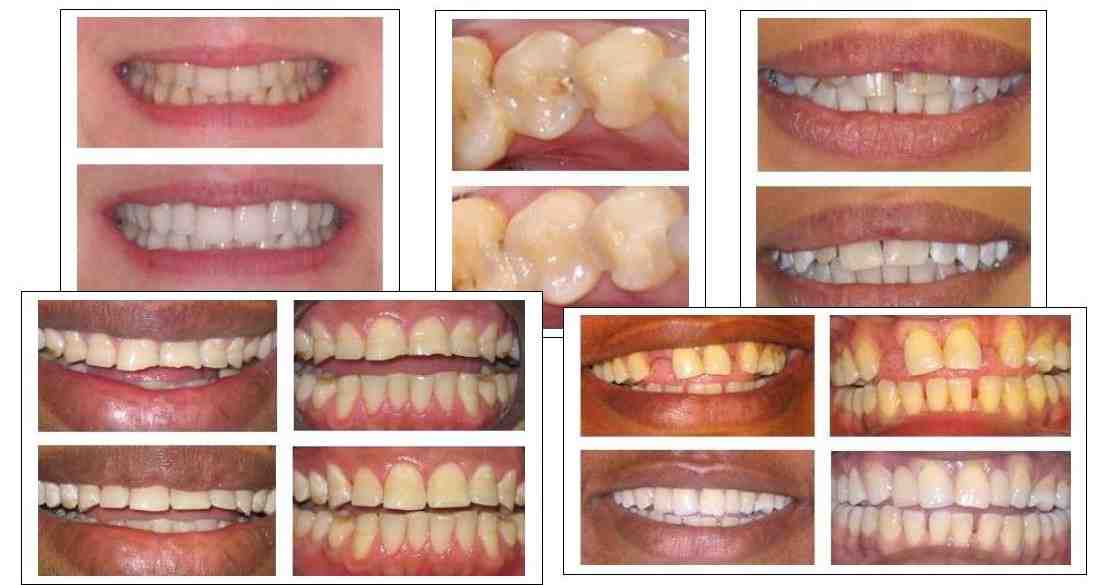 How much does a smile makeover cost in South Africa?