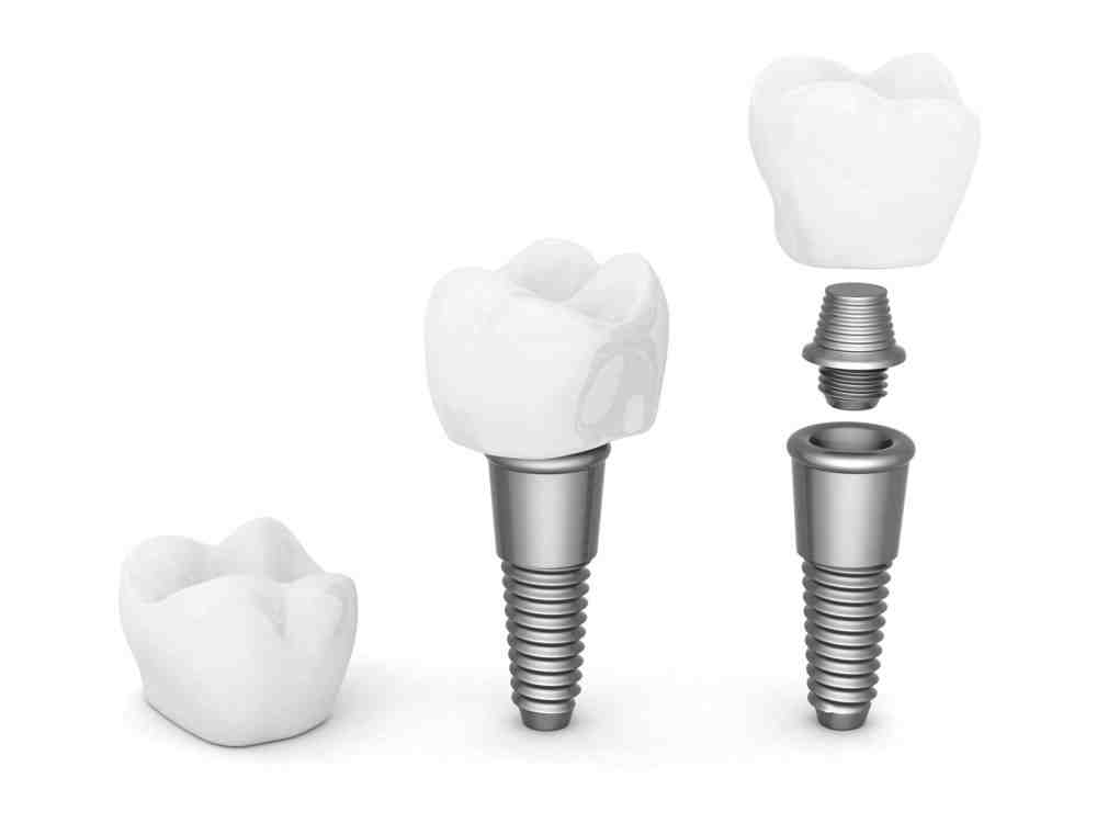 How much does a typical dental crown cost?