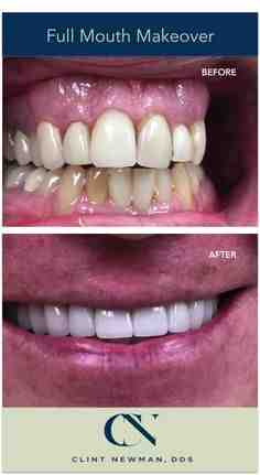 How much is a set of veneer teeth?