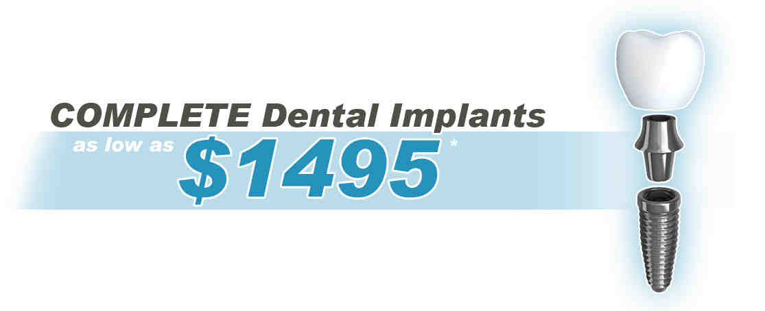 How much should dental implants cost in 2020?