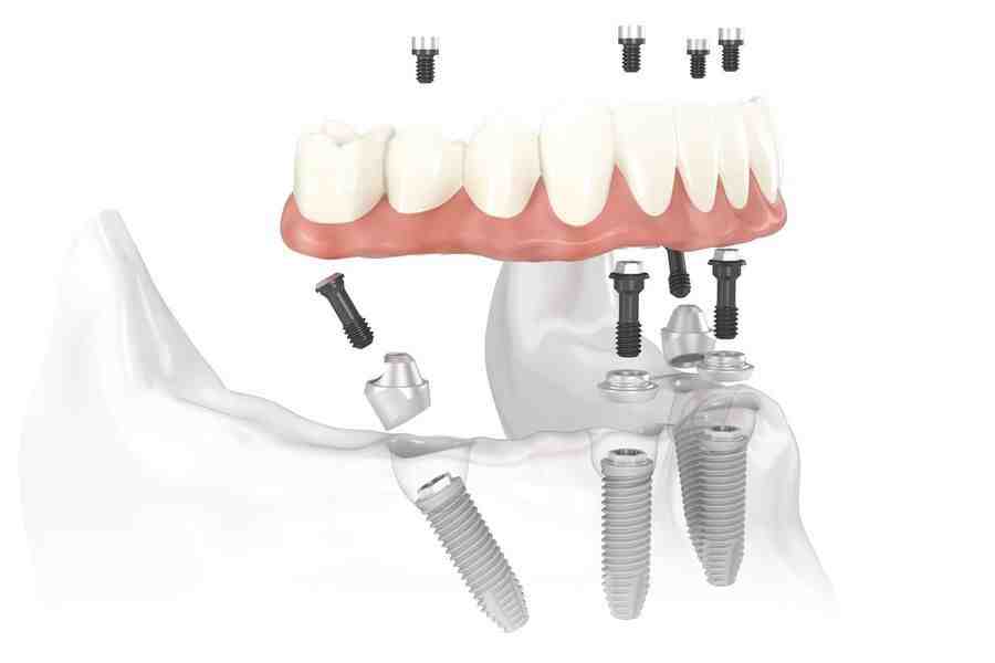 What dental implants should cost in 2020?