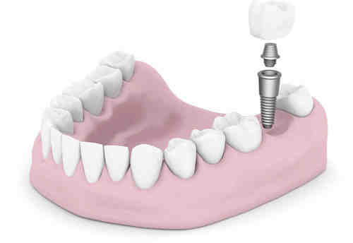 What is the best price for dental implants?