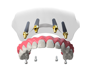 What is the lowest cost for dental implants?