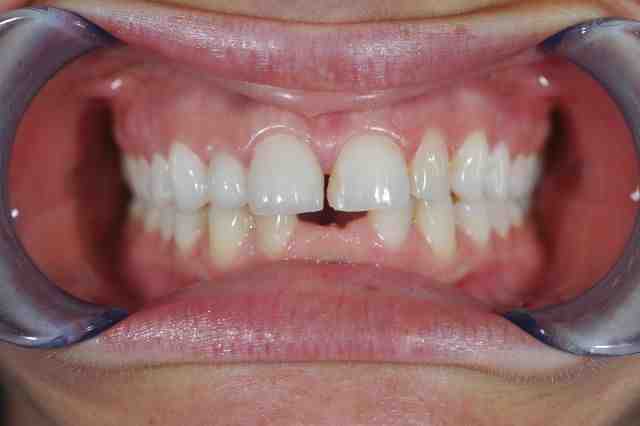 What type of dentist is best for crowns?