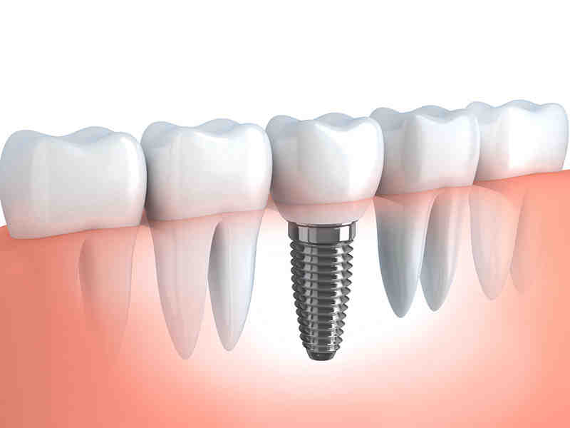 Dental implant dentist in north san diego county