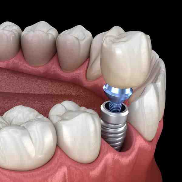 Does healthnet cover dental crowns?