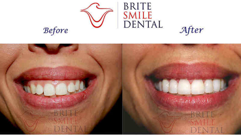 How Much Does Dentist Coast In San Diego Elite Dentists