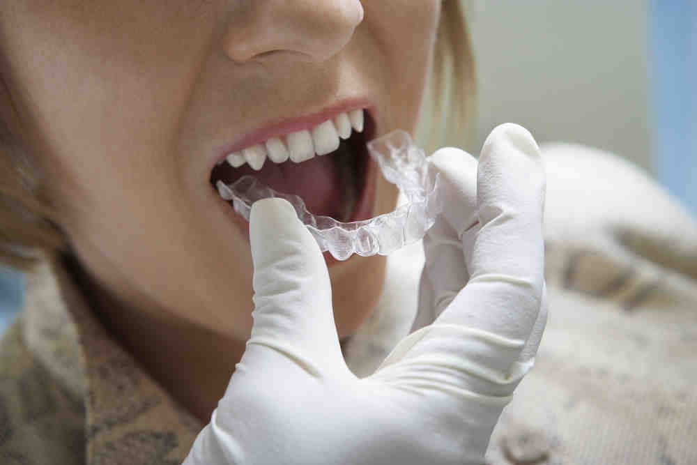 How do you straighten teeth if you can't afford braces?
