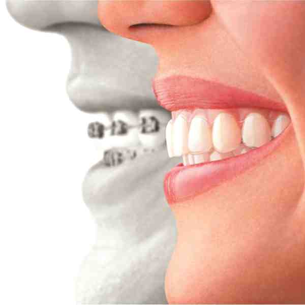 How much does Invisalign cost in San Diego?