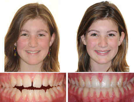 How much does Invisalign cost in San Diego?