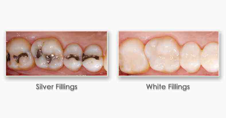 How much does a filling cost out of pocket?