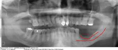 How much does it cost to straighten teeth?