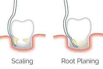 How much is a dental cleaning without insurance?