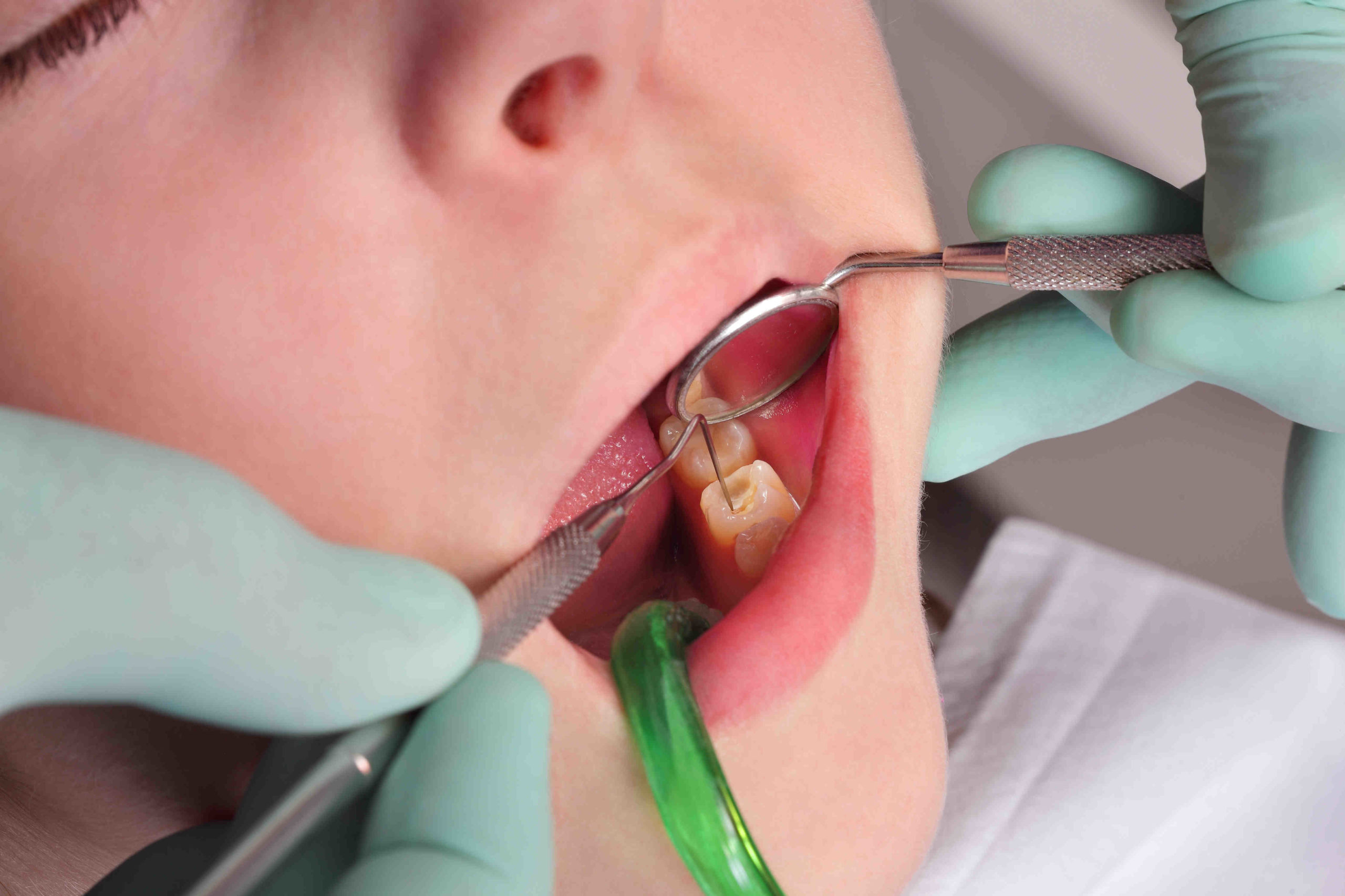How much should a cavity filling cost?