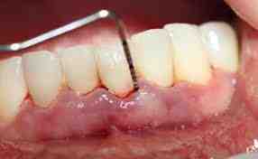 How much should a deep teeth cleaning cost?