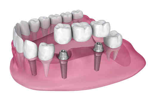 How much should dental implants cost in 2020?