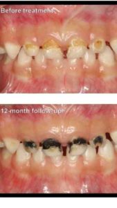 List of dentists in san diego that use silver diamine fluoride - Elite