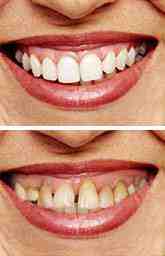 Lanap dentist in san diego