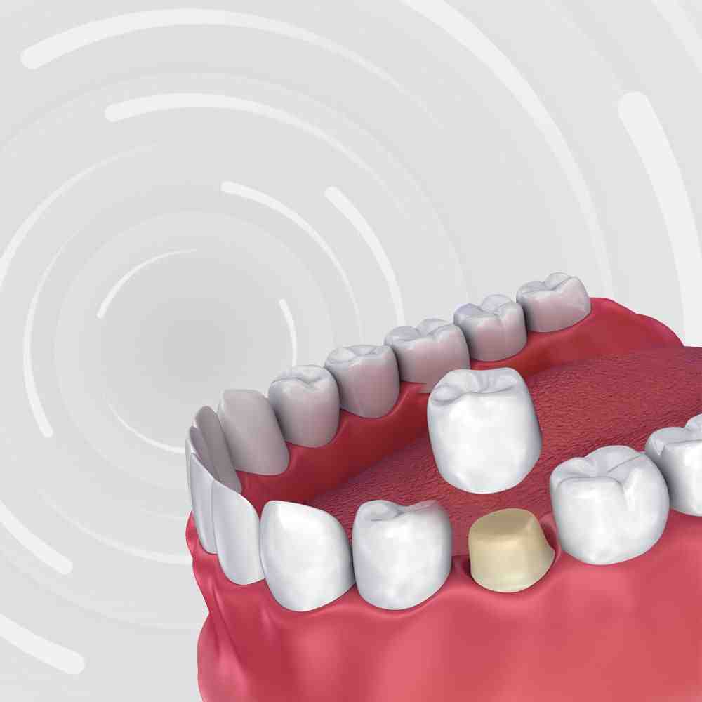 What is the average cost of a dental crown in California?