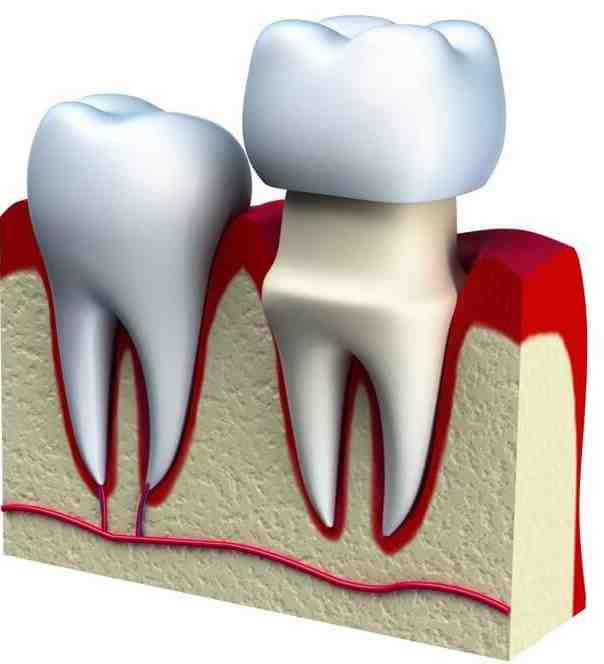 What type of dentist is best for crowns?