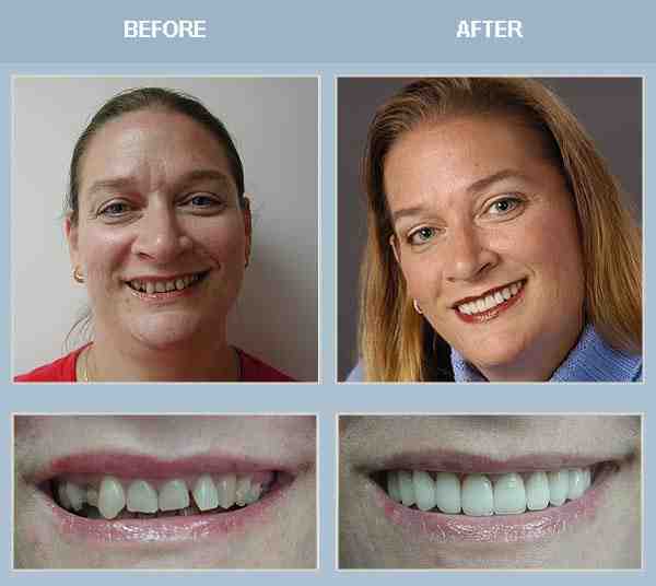 Do dentists offer payment plans veneers?