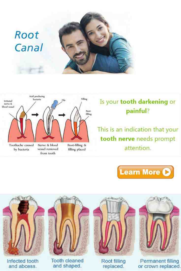 Does Medi cal cover root canals?