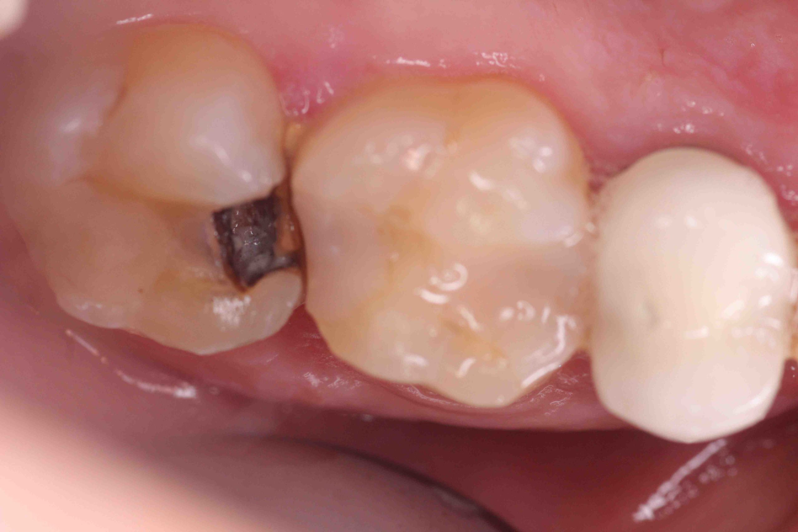 Does Medi cal cover root canals?