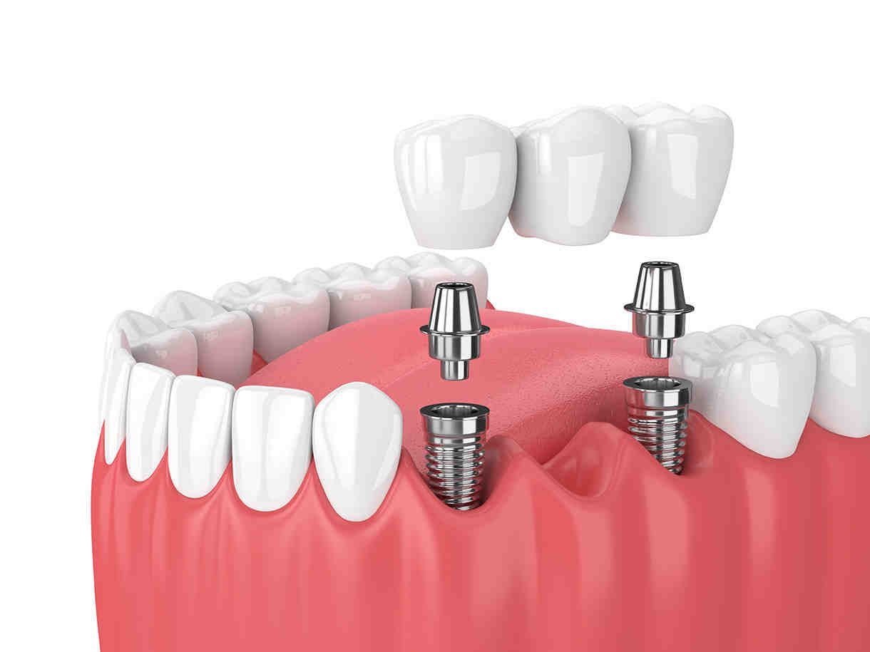 How much are dental implants California 2020?