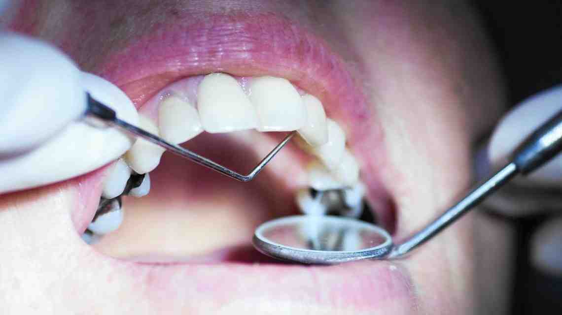 How much do dental implants cost in San Diego?