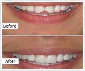 How much do veneers cost in California?