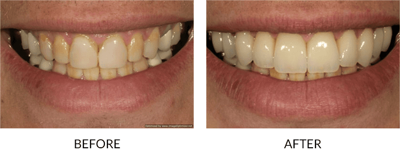 How much do veneers cost in California?