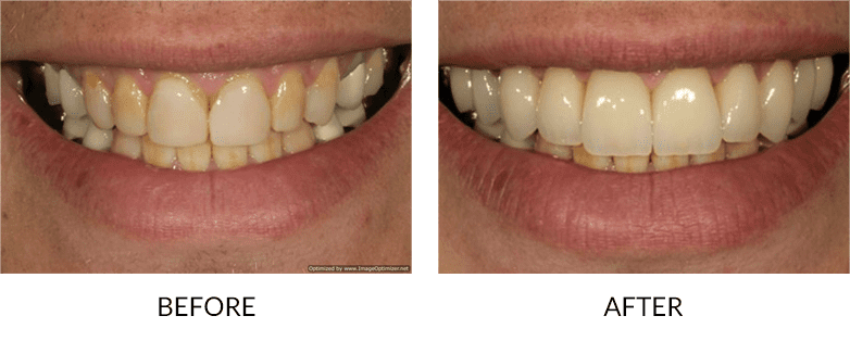 How much do veneers cost in San Diego?
