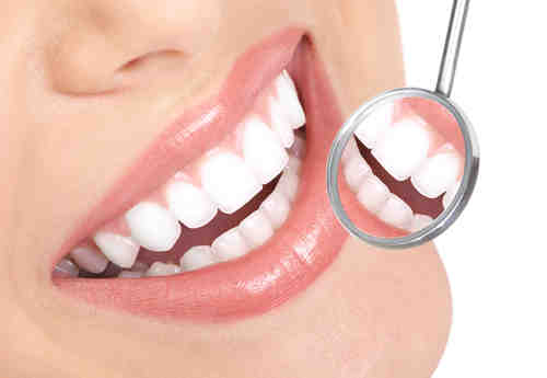 How much do veneers cost in San Diego?