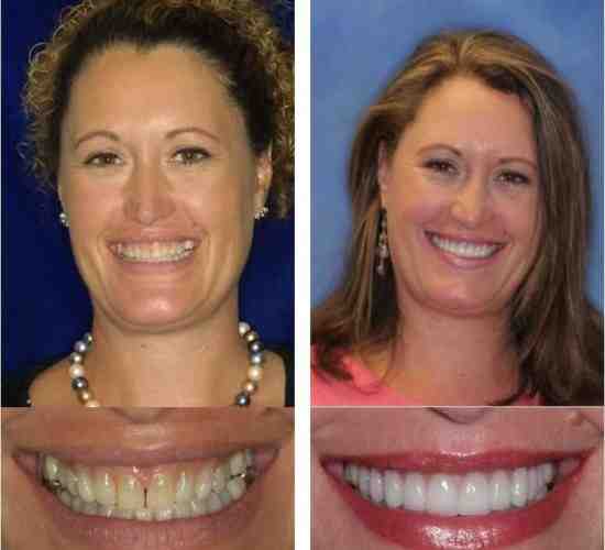 How much is a set of veneer teeth?