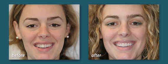 San diego invisalign dentist