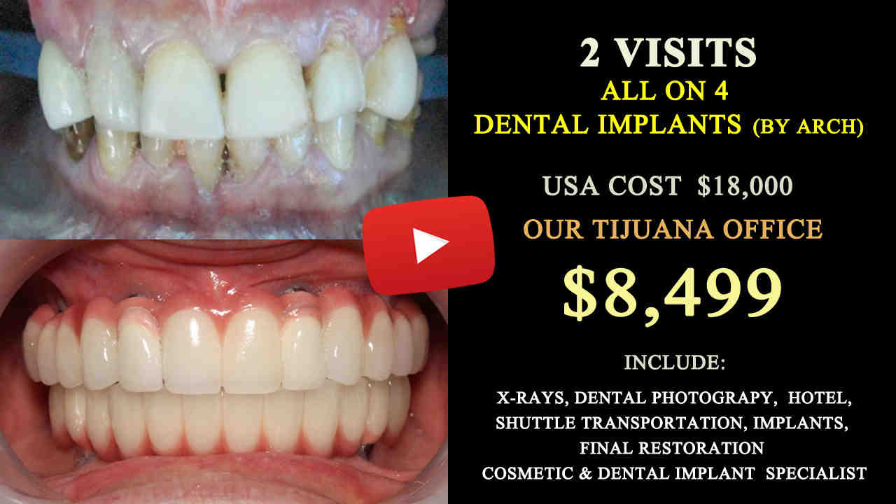 Should I go to Tijuana for Dental Work?