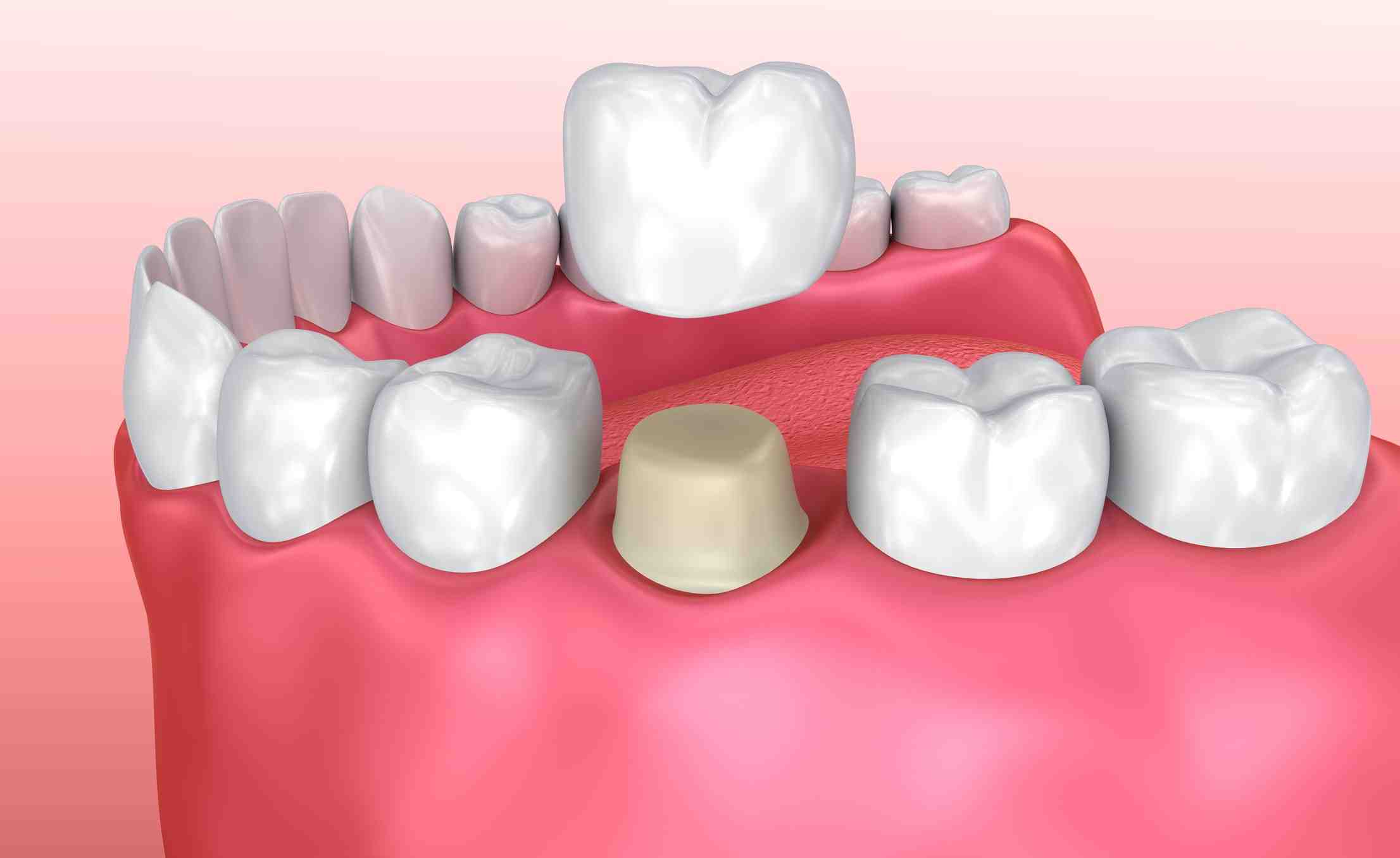 What are the most comfortable dentures?