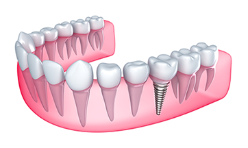 What is the cheapest price for dental implants?